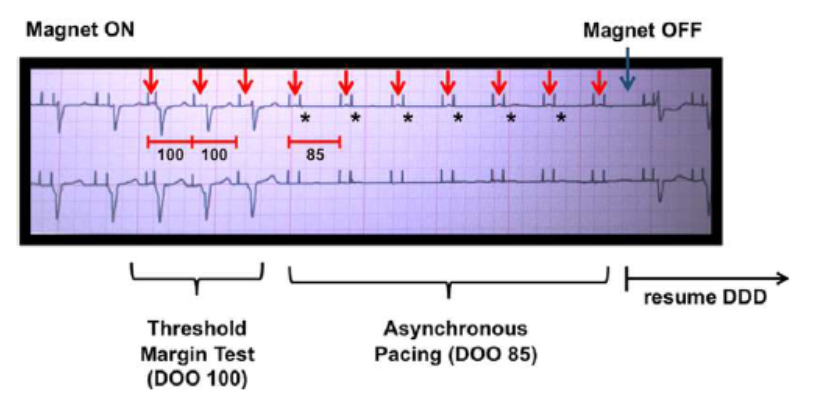asystole during pacemaker magnet application 1
