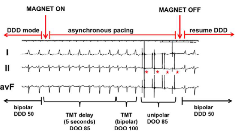 asystole during pacemaker magnet application 2