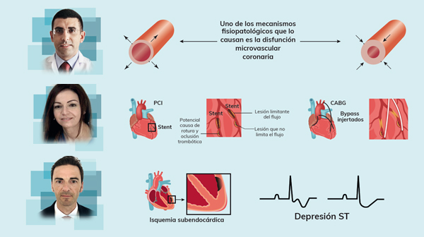 Retos en intervencionismo percutáneo coronario: punto de encuentro entre cardiólogos clínicos e intervencionistas