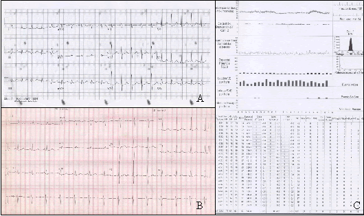 miocardiopatia-taquicardia-sinusal-inapropiada-figura-1