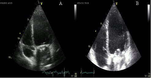 miocardiopatia-taquicardia-sinusal-inapropiada-figura-2