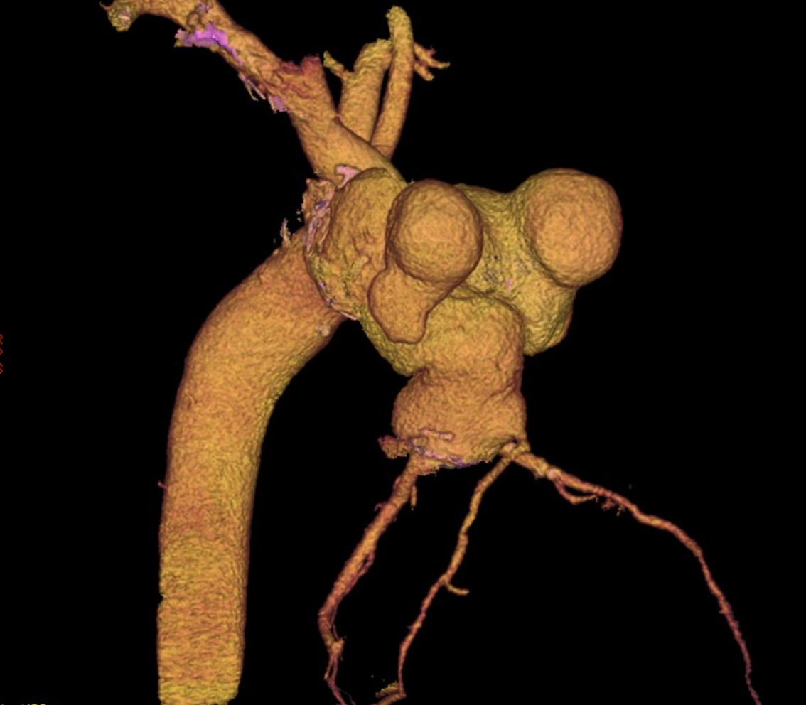 Mantis aórtica: estudio de la aorta a través de CT